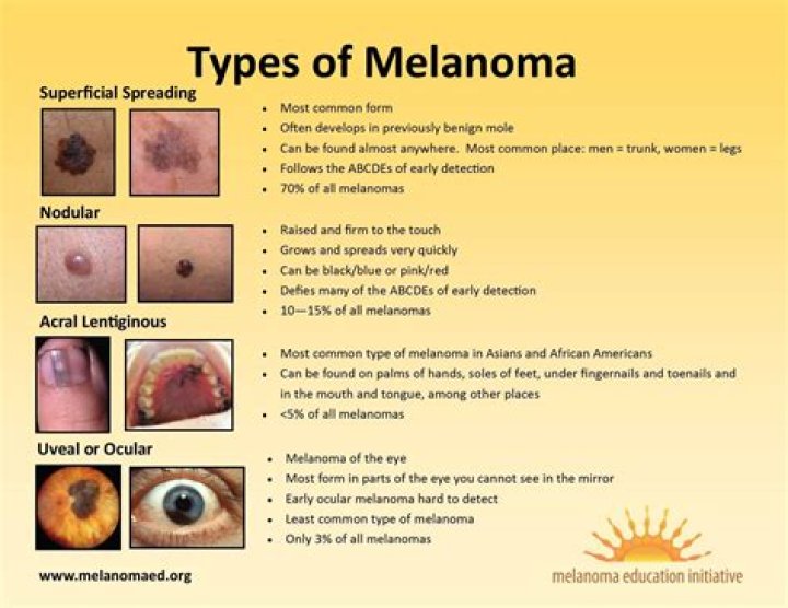 Are melanomas always black?