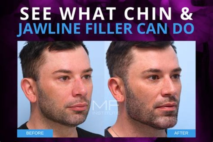 Can chin filler migrate to double chin?