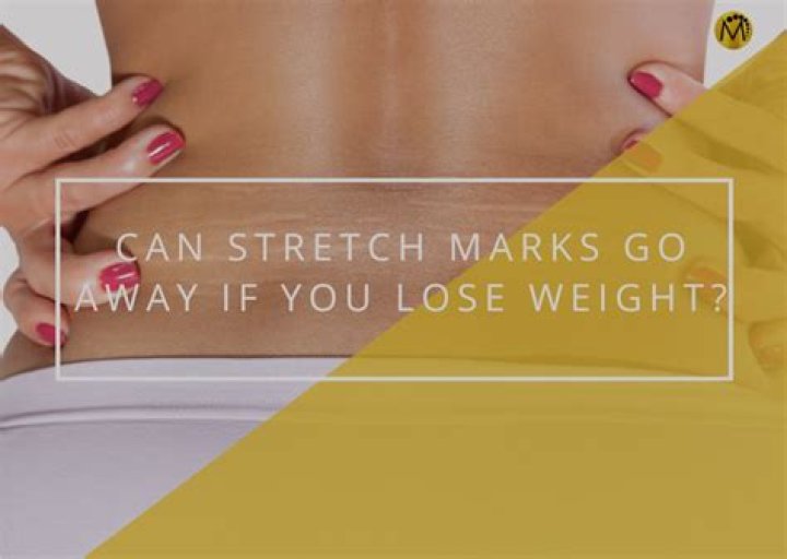Do stretch marks on thighs go away?