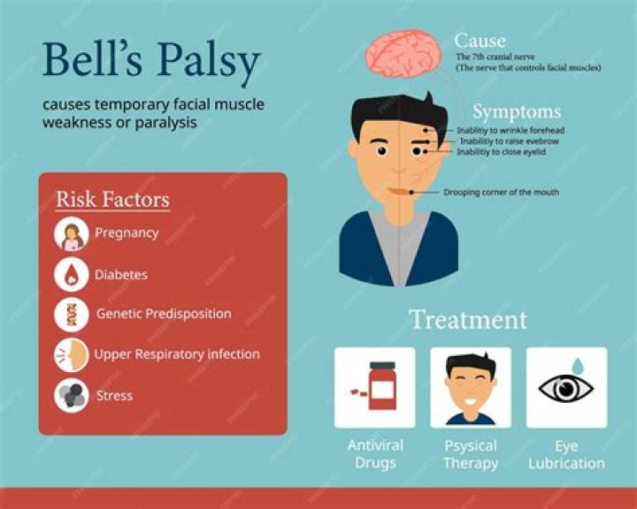 What causes Bell's palsy stress?
