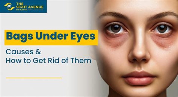 What do eye bags indicate?