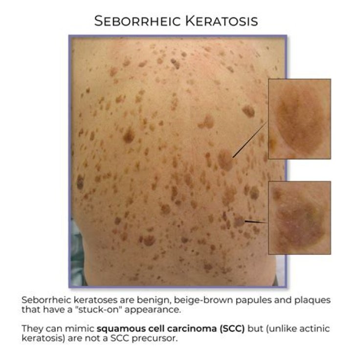 What do Seborrhoeic keratosis look like?
