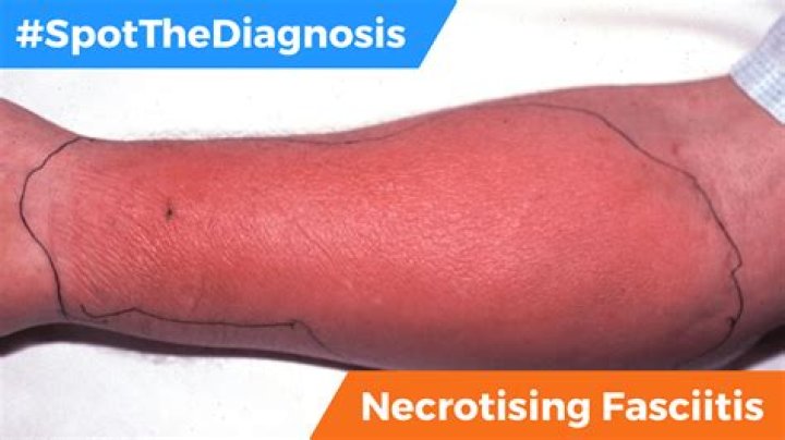 What does early skin necrosis look like?