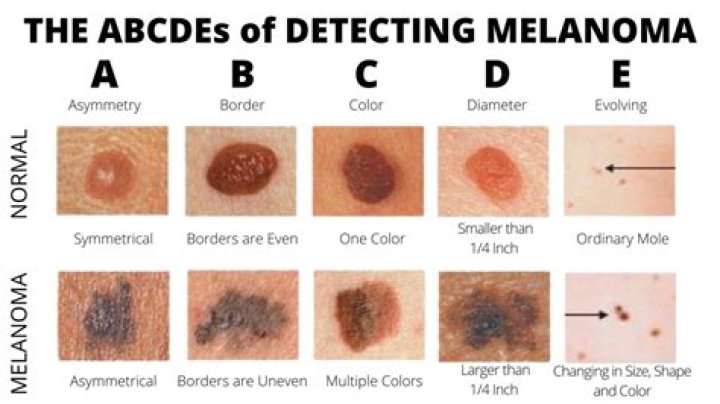 Where does scalp melanoma spread first?