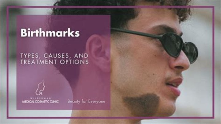 Why are birthmarks called birthmarks?